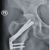 From Valgus-impacted to Displaced: Clinical and Technical Lessons in Femoral Neck Fracture Fixation with the Femoral Neck System