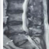 Unilateral Bi-portal Endoscopic Spinal Surgery for Lumbar Disk Herniation and Canal Stenosis: Technical Nuances and Fellowship-Based Clinical Experience