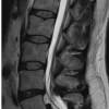 Sacral Insufficiency Fracture Following L4–S1 Circumferential Fusion in Corticosteroid-associated Bone Fragility: A Case Report and Biomechanical Considerations