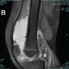 Post-traumatic Hemosiderotic Synovitis Mimicking Pigmented Villonodular Synovitis in a Non-hemophilic Child: First Reported Case from the United Arab Emirates