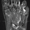 Complex Irreducible Dislocation of the Fourth Toe Proximal Interphalangeal Joint in a 5-year-old Boy Fixed by Soft Anchor: A Case Report