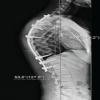 Proximal Junctional Kyphosis Following Spinal Thoracic Deformity Correction in a Patient with Kabuki Syndrome: A Case Report