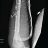 Ballistic Galeazzi Fractures: A Case Series