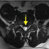 Recurrent Symptoms in Lumbar Disc Herniation with Concomitant Schwannoma: The Role of Tumor Microenvironment and Anti-Inflammatory Therapy