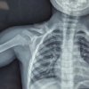Clavicle Fracture Non-Union in a 3-Year-Old Child: A Case Report and Literature Review