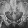 Evaluation of Spine Hip Relation and its Correlation as a Guide to Total Hip Arthroplasty