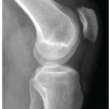 Symptomatic Intratendinous Ganglion Cyst of the Patellar Tendon: Case Report and Review of the Literature