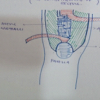Injection-Induced Quadriceps Contracture Treated with Distal Quadricepsplasty: A Case Series