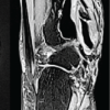 Patient-specific Distal Tibia Prosthesis for Reconstruction in a Case of Recurrent Giant Cell Tumor – A Case Report