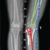 Salvage of a Broken Magnetic Tibia Nail with Plate Fixation Without Nail Removal: A Case Report