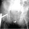 Intraoperative Traction for Cephalomedullary Nailing in Amputation Patients
