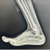 A Rare Case of Calcaneal Osteochondroma: Case Report