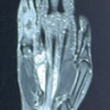 Tubercular Compound Palmar Ganglion Presenting with Chronic Wrist Swelling and Flexor Dysfunction: A Case Report