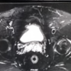 Painful Chondral Delamination in Early-Stage Osteonecrosis of the Femoral Head Precipitating Total Hip Arthroplasty
