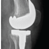 Conventional Total Knee Arthroplasty in Severe Anterolateral Femoral Bowing: Lateralized Femoral Entry Point to Approach Navigation Level Alignment – A Case Report