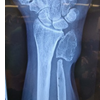 Reawakening of a Giant Cell Bone Tumor after 40 Years of Silence: A Rare Case Report