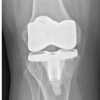 Extended Antibiotic Spacer use in an Infected Total Knee Arthroplasty with Mycobacterium intracellulare – A Case Report