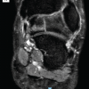 Avascular Necrosis of the Talar Body Presenting with a Vertical Fracture and Dome Collapse in a Low-Risk Patient: A Case Report