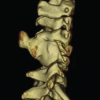 A Case Report of Cervical Digit: Heterogeneous Condition
