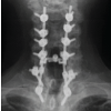 Delayed Esophageal Perforation 14 Years after Cervical Anterior Decompression and Fusion: A Case Report