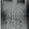 Removal of Hartshill Rectangle and Wires with Revision Pedicle Screw Fixation: Technical Challenges, Safety Considerations, and Clinical Outcomes in Complex Spinal Reconstruction – A Case Report