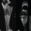 Challenging Limb Salvage in a Crural Malignant Peripheral Nerve Sheath Tumor with Pre-existing Long-Stem Implants: A Case Report