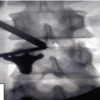 Outcomes of Unilateral Biportal Endoscopic Surgery for Prolapsed Intervertebral Disc: A Single-center Study