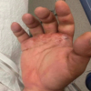 Management of Naja kaouthia Envenomation at a Quaternary Urban Medical Center: A Case Report