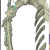 Humerus Non-union with Segmental Bone Loss Treated with 3D-printed Prosthesis: A Case Report
