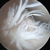 Arthrex Labral Scorpion for Anterior Cruciate Ligament Repair: A Novel Application for this Instrument: Case Report