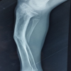 Oblique Plane Deformity Correction with Ilizarov Fixator in Ipsilateral Proximal Tibia Growth Arrest and Malunited Tibia: A Case Report