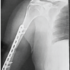 Anterior Minimally Invasive Plate Osteosynthesis Versus Open Reduction Plate Osteosynthesis in Humeral Diaphyseal Fractures: A Functional and Clinical Analysis