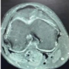 A Case of In Situ Fixation of Large Lateral Condyle Femur Osteochondral Defect Secondary to Trauma in a Young Male – A Case Report