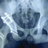 Total Hip Replacement Following Unsuccessful Acetabular Repair: A Case Report