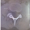 Unusual Presentation of Spinal Osteoid Osteoma: A Case Report