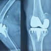 A Case of Catastrophic Failure of Tibial Component with Extensive Metallosis Following Total Knee Arthroplasty: A Case Report