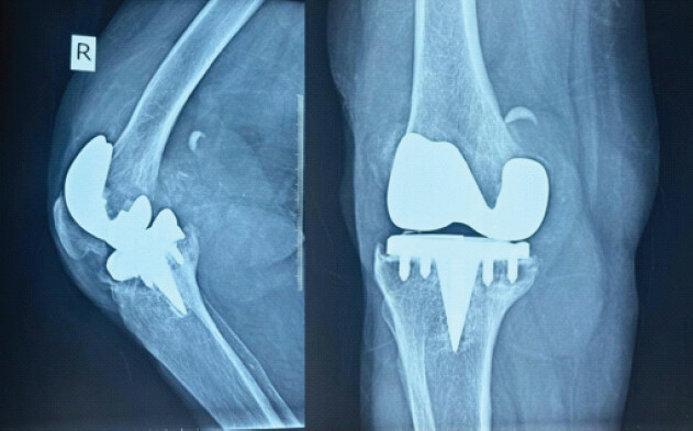 Figure 1: Anteroposterior and lateral radiographs of the right knee showing significant wear of the tibial component on the medial side after complete degradation of the polyethylene inlay.