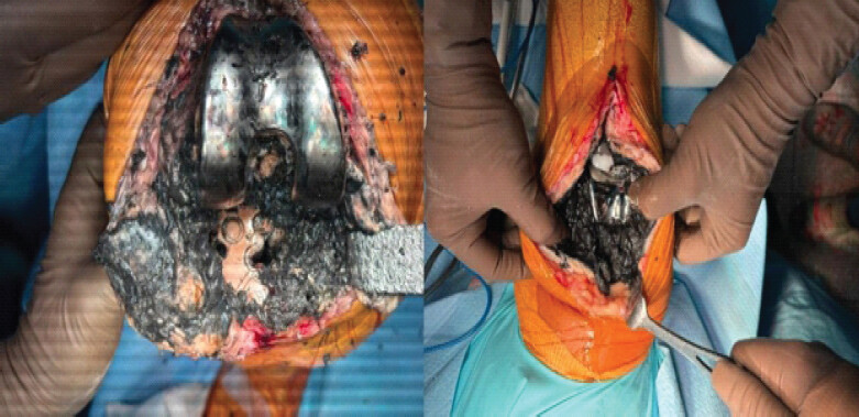 Figure 2: Intraoperative photograph showing extensive black staining of the synovium, joint fluid, and surrounding soft tissue, consistent with metallosis.