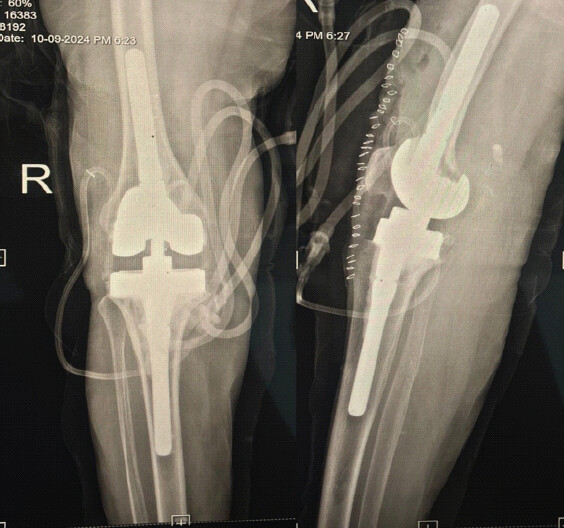 Figure 4: Intraoperative/radiographic image showing the revision implants, comprising press-fit diaphyseal stems and a constrained component with tibial wedges.