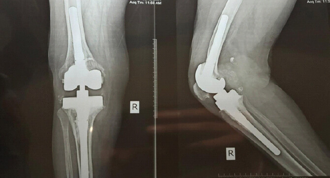 Figure 5: One-year follow-up radiographs of the right knee showing a well-positioned prosthesis with no evidence of loosening or osteolysis.