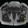 Incidental Intramedullary Lipoma of the Proximal Femur Detected Following Trauma: A Case Report