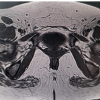 Posterior Femoral Neck Exostosis in a Young Adult: Open Resection and Prophylactic Dynamic Hip Screw Fixation – A Case Report