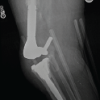 Acute Post-operative Lumbar Paraspinal Compartment Syndrome Following Revision Total Joint Arthroplasty: A Case Report