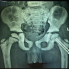 A Rare Case of Left Femoral Neck Fracture in a 6-Year-Old Boy with Osteopetrosis