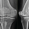 A Novel Technique of Rerouting Semitendinosus Graft for Medial Collateral Ligament and Medial Patellofemoral Ligament Reconstruction – In a Polytrauma Patient with Multiligament Injury: Kakran et al. Technique