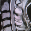 A Clinical Experience in Treating Myelopathy Caused by Floating Lamina Resulting from Re-close of the Lamina and Pseudarthrosis at the Lateral Gutter after Cervical Laminoplasty
