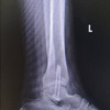 Dual-Screw Fixation for Chronic Syndesmotic Injury: A Case Report
