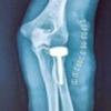 Comparison of Radial Head Prosthesis versus Excision in Comminuted Radial Head Fractures: A Retrospective Comparative Study
