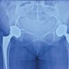 Total Hip Arthroplasty in Bilateral Ankylosed Hip by Direct Anterior Approach: A Case Report with Technical Tips