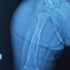 Solitary Diaphyseal Langerhans Cell Histiocytosis of Femur in an Infant – A Case Report